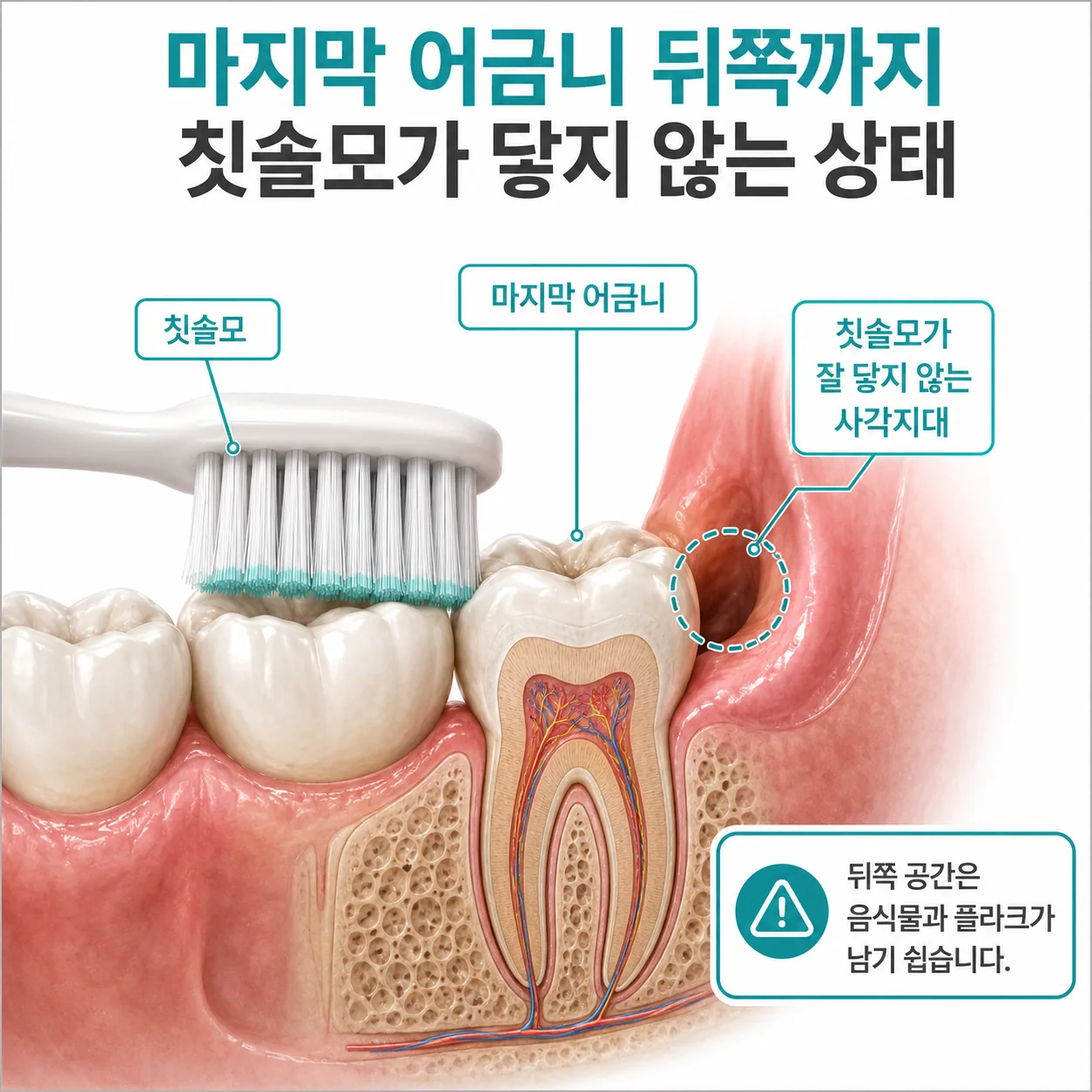 사랑니 뒤쪽에 칫솔이 닿지 않는 단면 그림