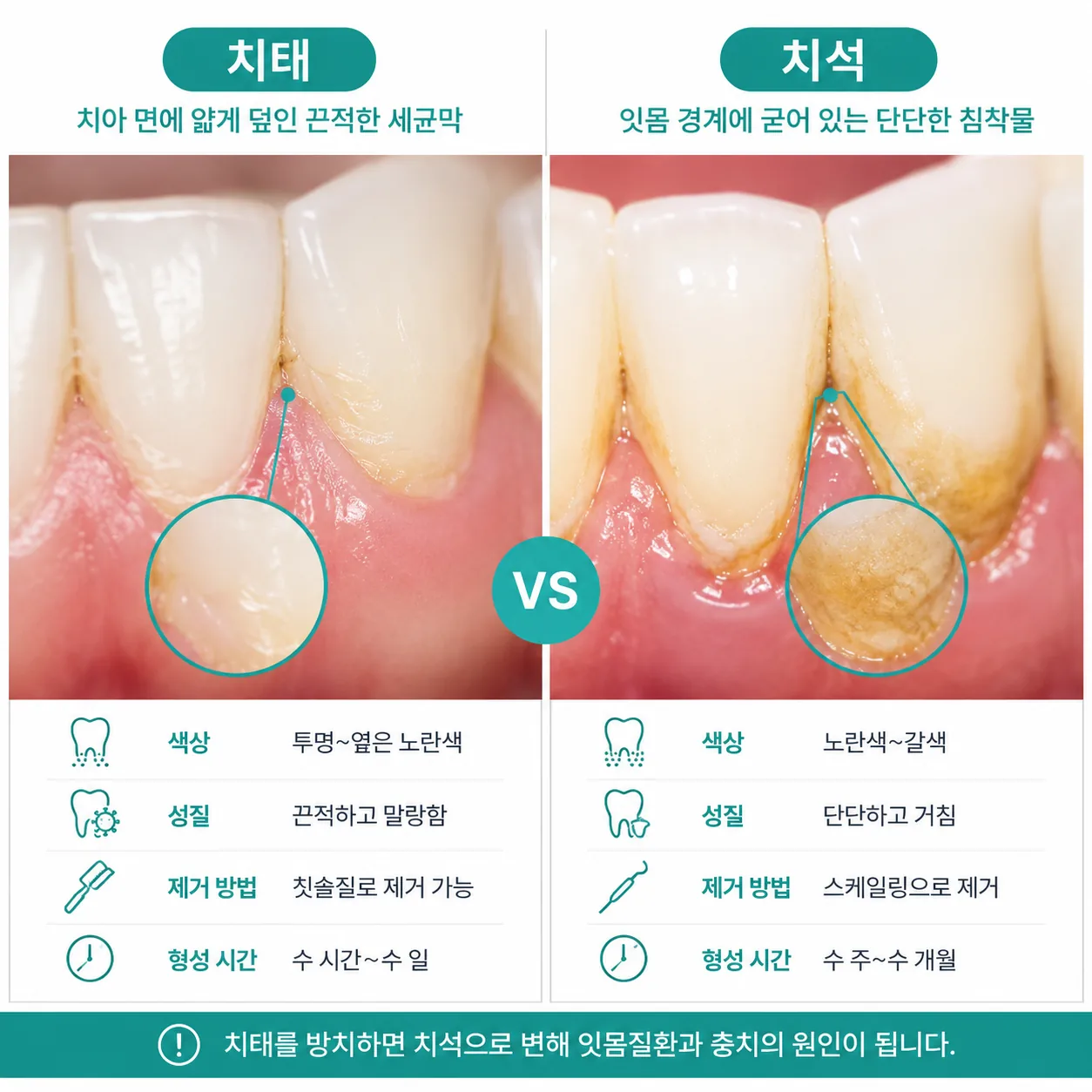 치태와 치석의 차이를 비교한 그림
