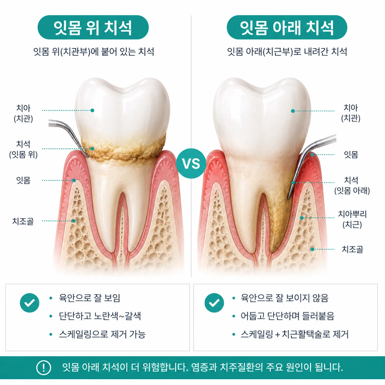 잇몸 위 치석과 잇몸 아래 치석의 위치를 비교한 단면 그림