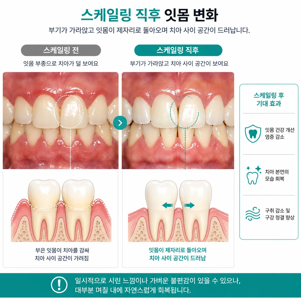 스케일링 직후 잇몸 변화와 치아 사이 공간을 설명한 그림