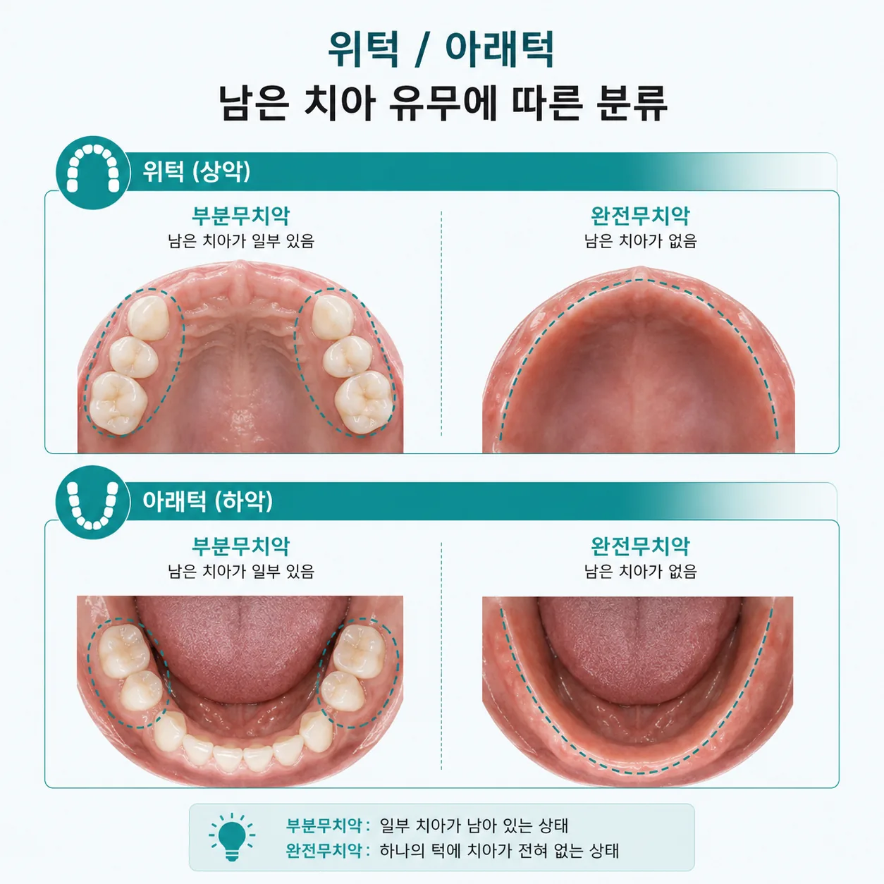 부분무치악과 완전무치악을 위턱·아래턱별로 구분한 그림