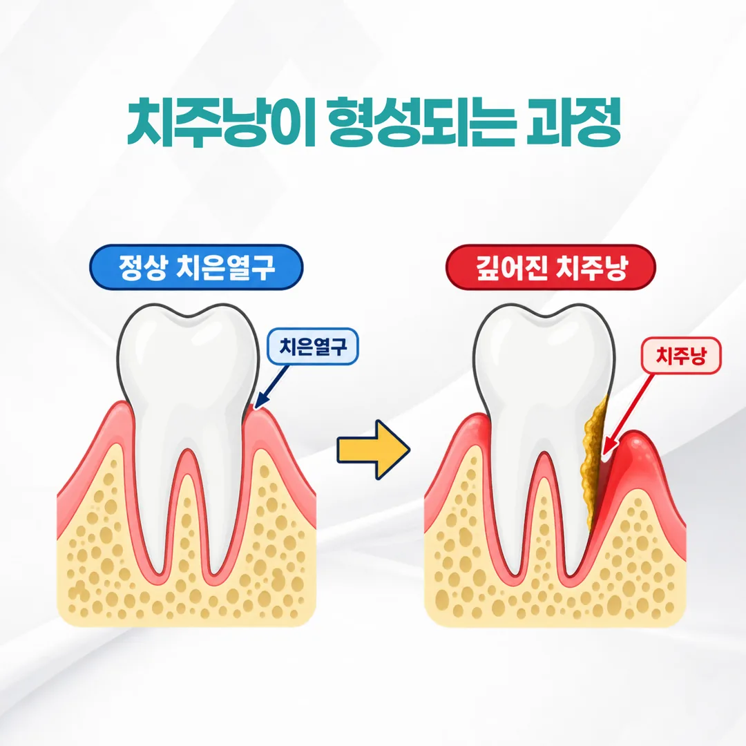 치은열구가 깊어져 치주낭이 형성되는 과정 단면도