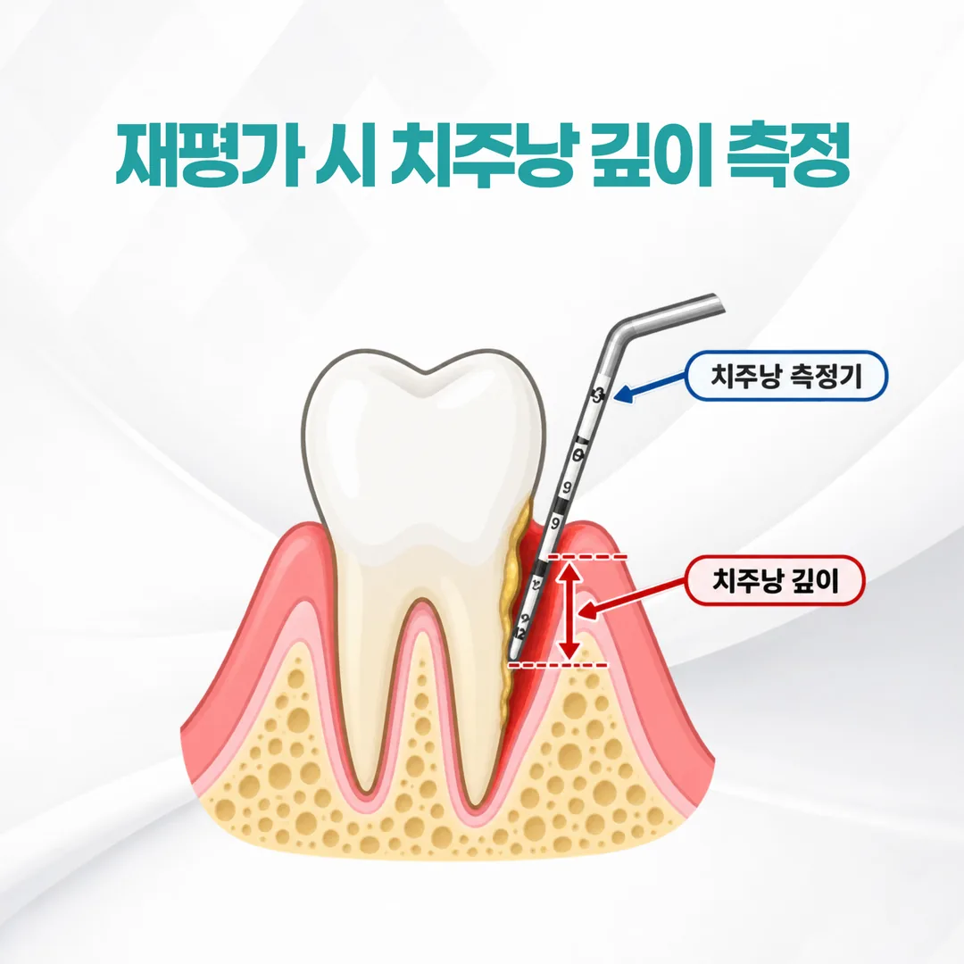 재평가 시 치주낭 측정기로 깊이를 다시 재는 도해