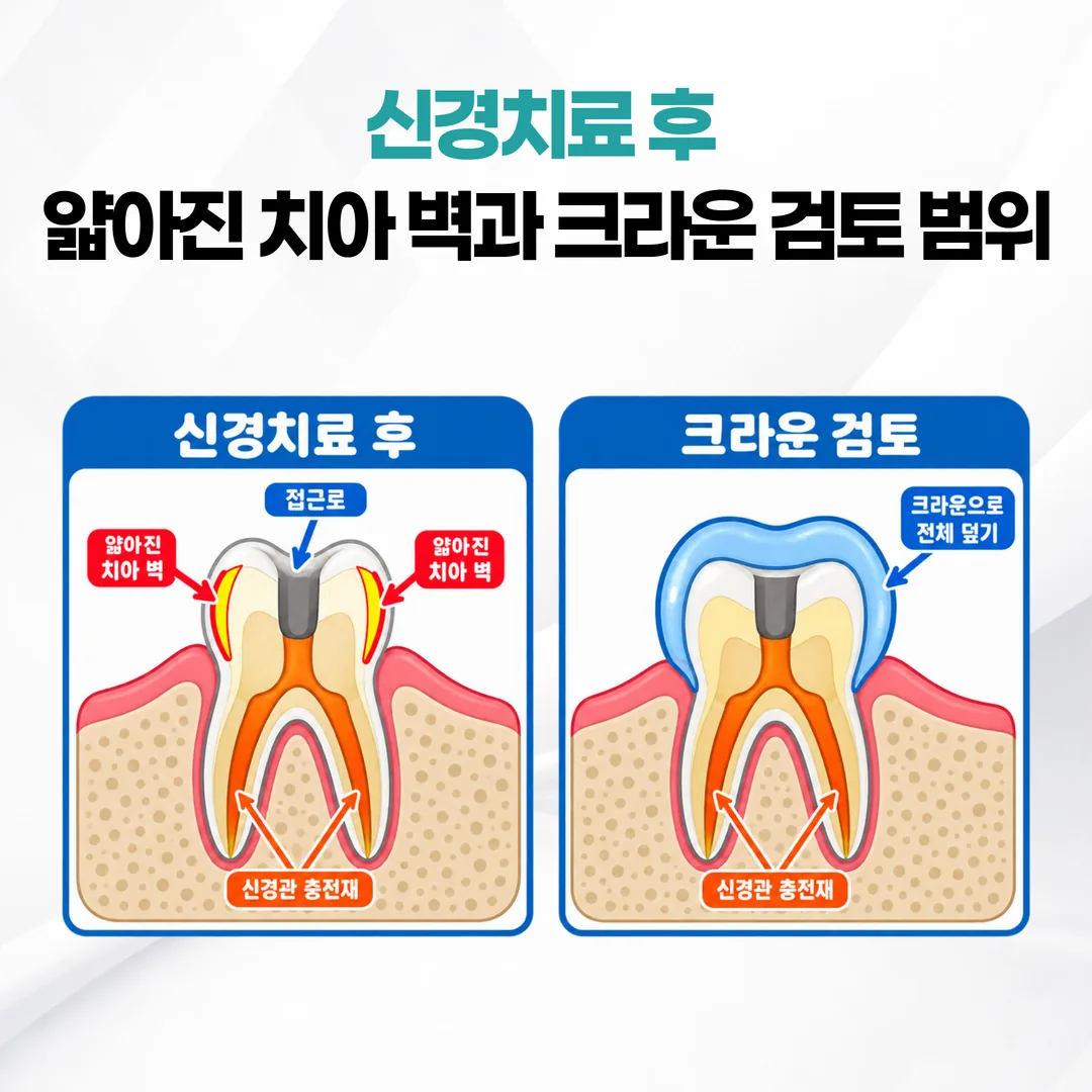 신경치료 후 얇아진 치아 벽과 크라운으로 감싸는 범위를 표시한 도식