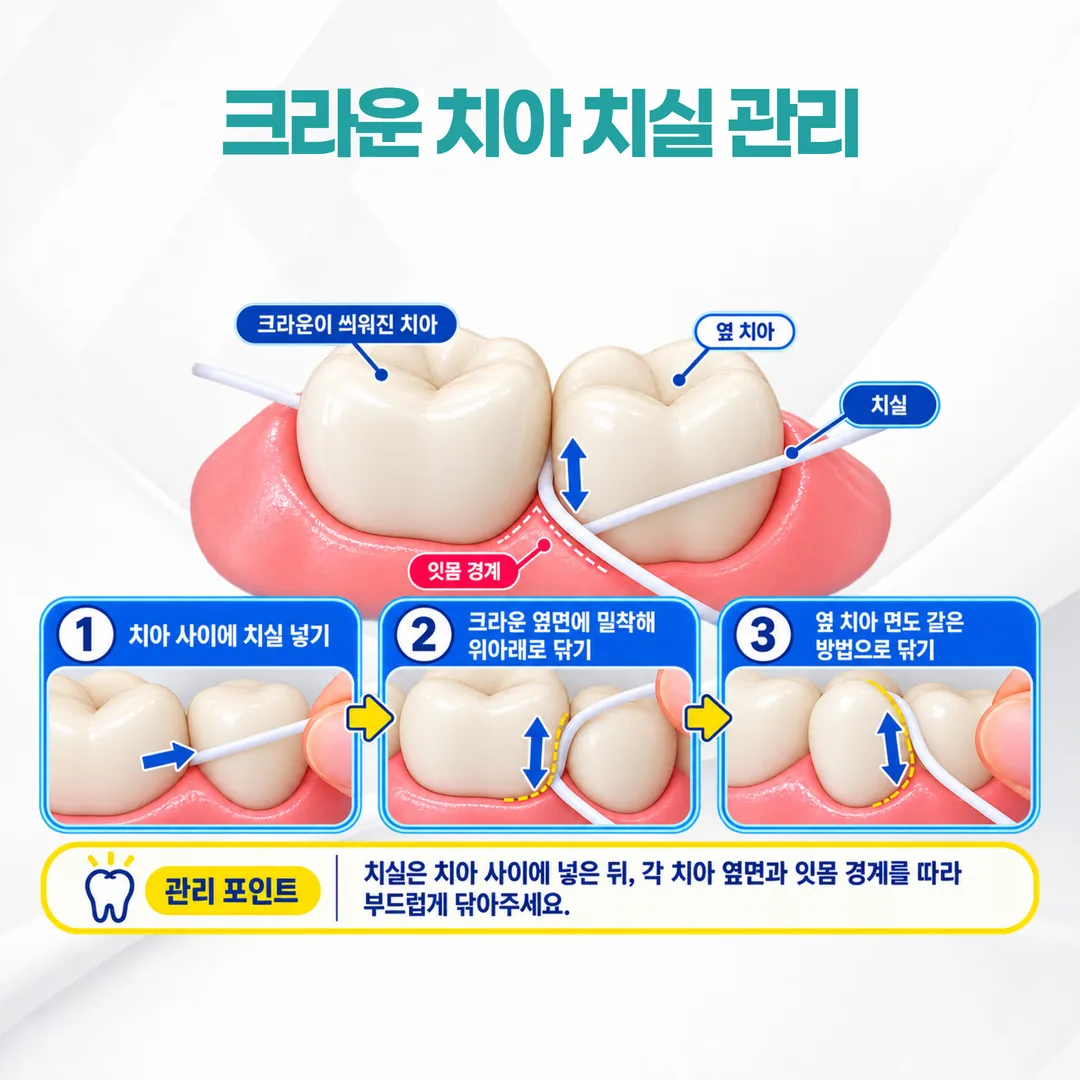크라운 경계선에 치실을 통과시키는 관리 동작 삽화