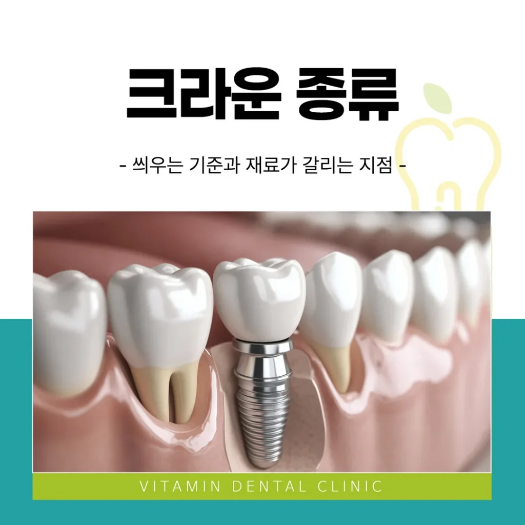 크라운 종류 — 씌우는 기준과 재료가 갈리는 지점
