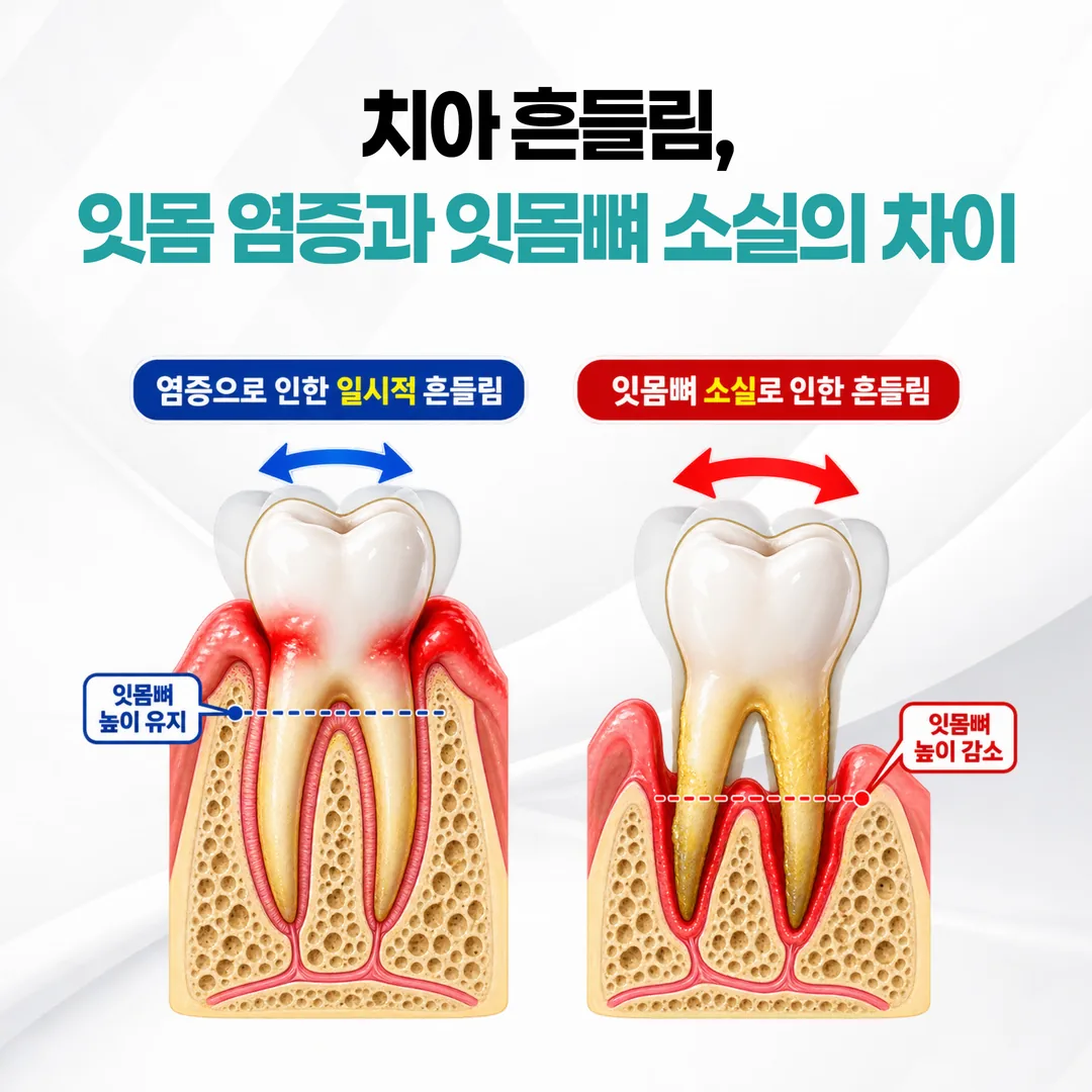 치아 흔들림 원인에 따른 잇몸뼈 상태 비교 그림