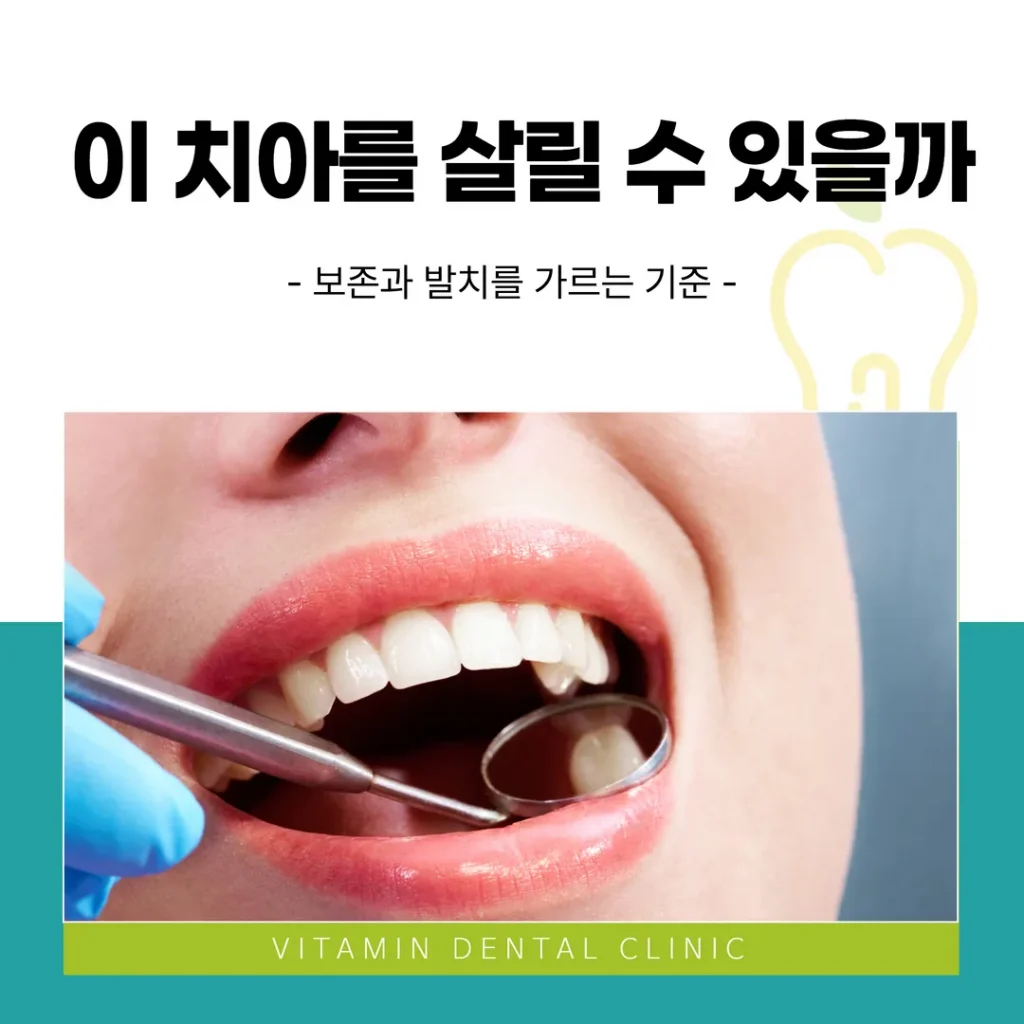 이 치아를 살릴 수 있을까 — 보존과 발치를 가르는 기준