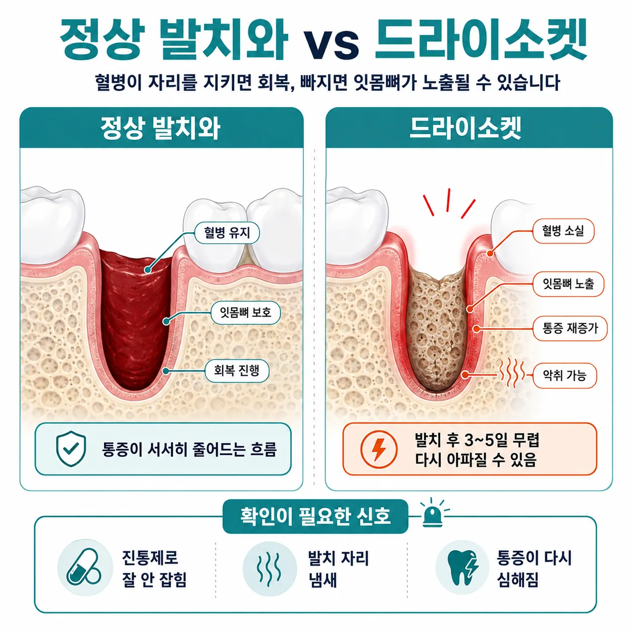 정상 발치와와 드라이소켓 단면 비교 도해
