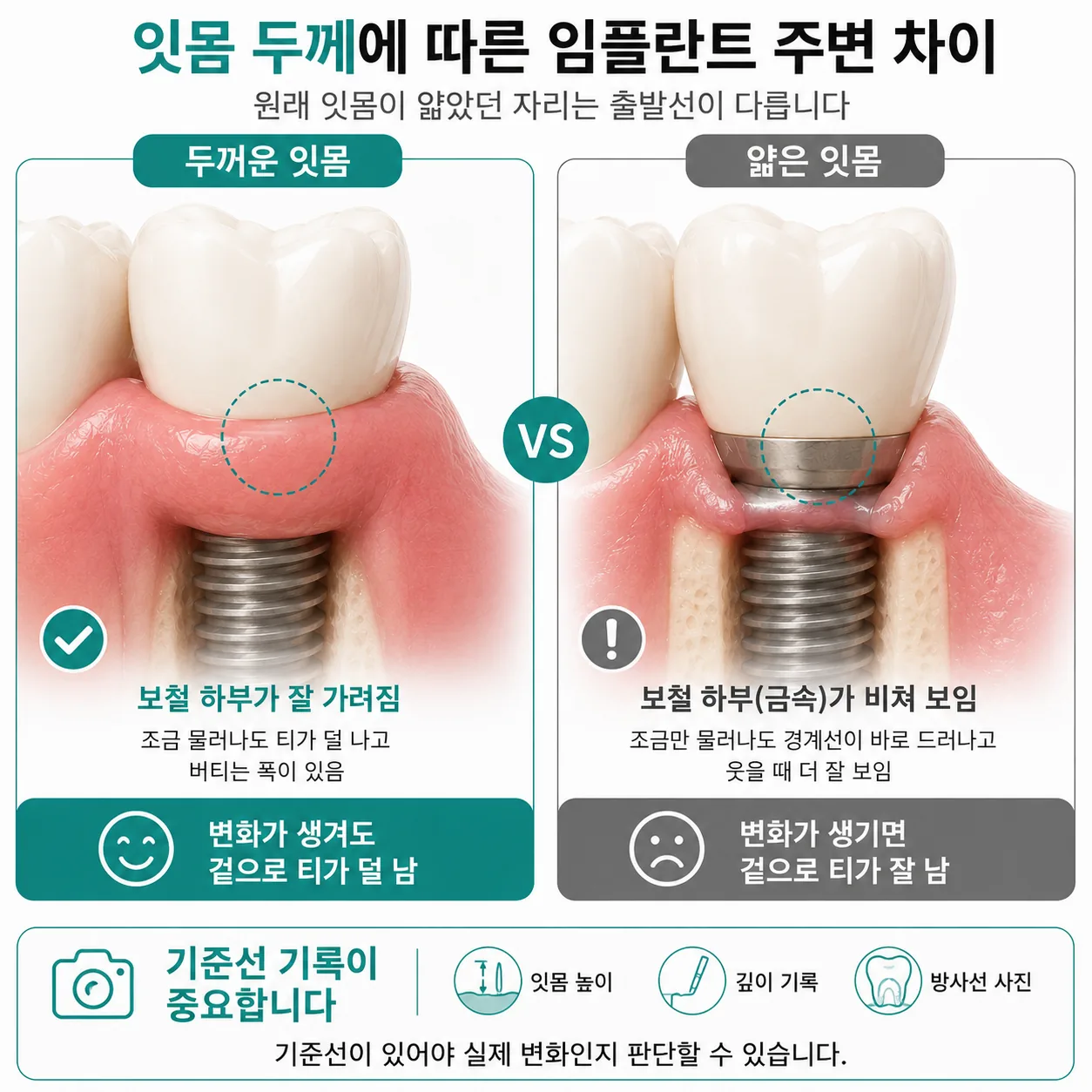 잇몸 연조직 두께에 따른 임플란트 주변 차이