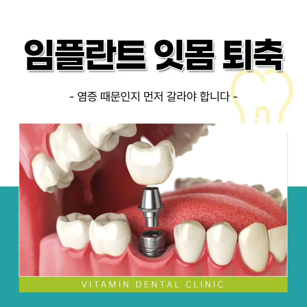 임플란트 잇몸 퇴축 — 염증 때문인지 먼저 갈라야 합니다