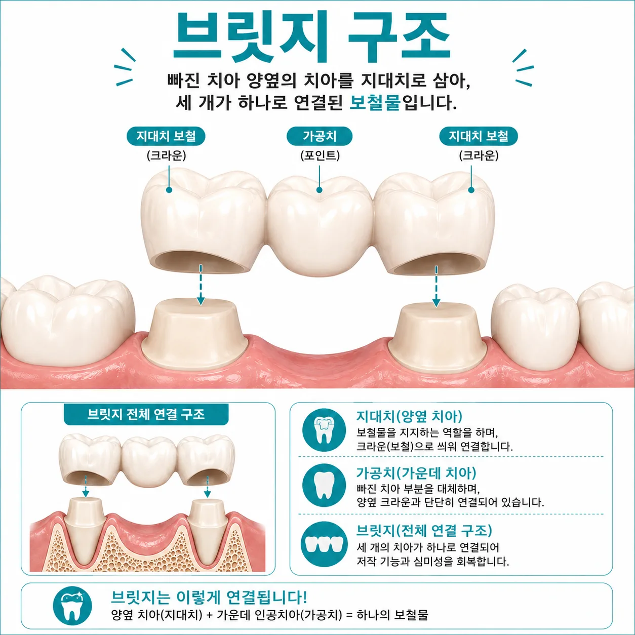 브릿지 구조 도해 — 양옆 지대치와 가운데 가공치