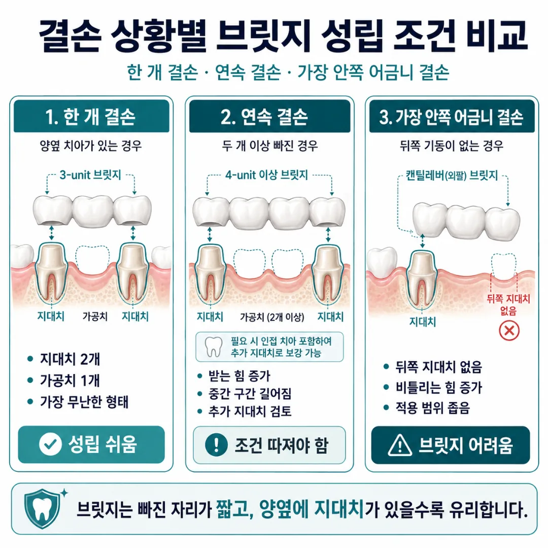 결손 상황별 브릿지 성립 조건 비교