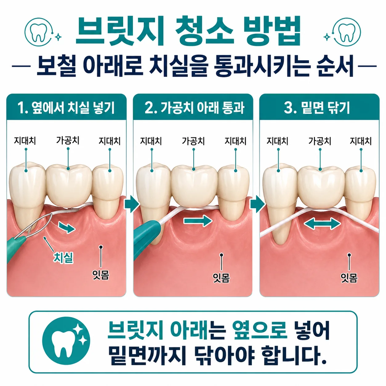 브릿지 청소 방법 — 보철 아래로 치실을 통과시키는 순서