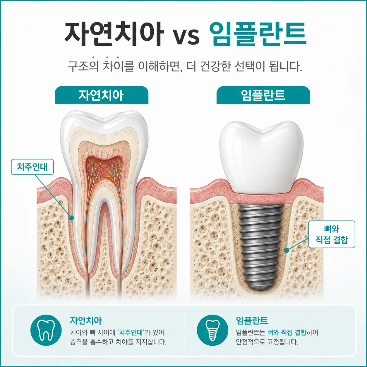 치주인대가 있는 자연치아와 인대 없이 뼈에 결합한 임플란트의 단면 비교