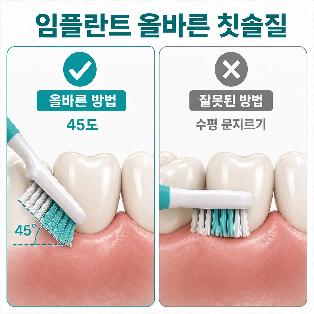 임플란트 보철 경계선에 칫솔을 45도로 대는 올바른 각도