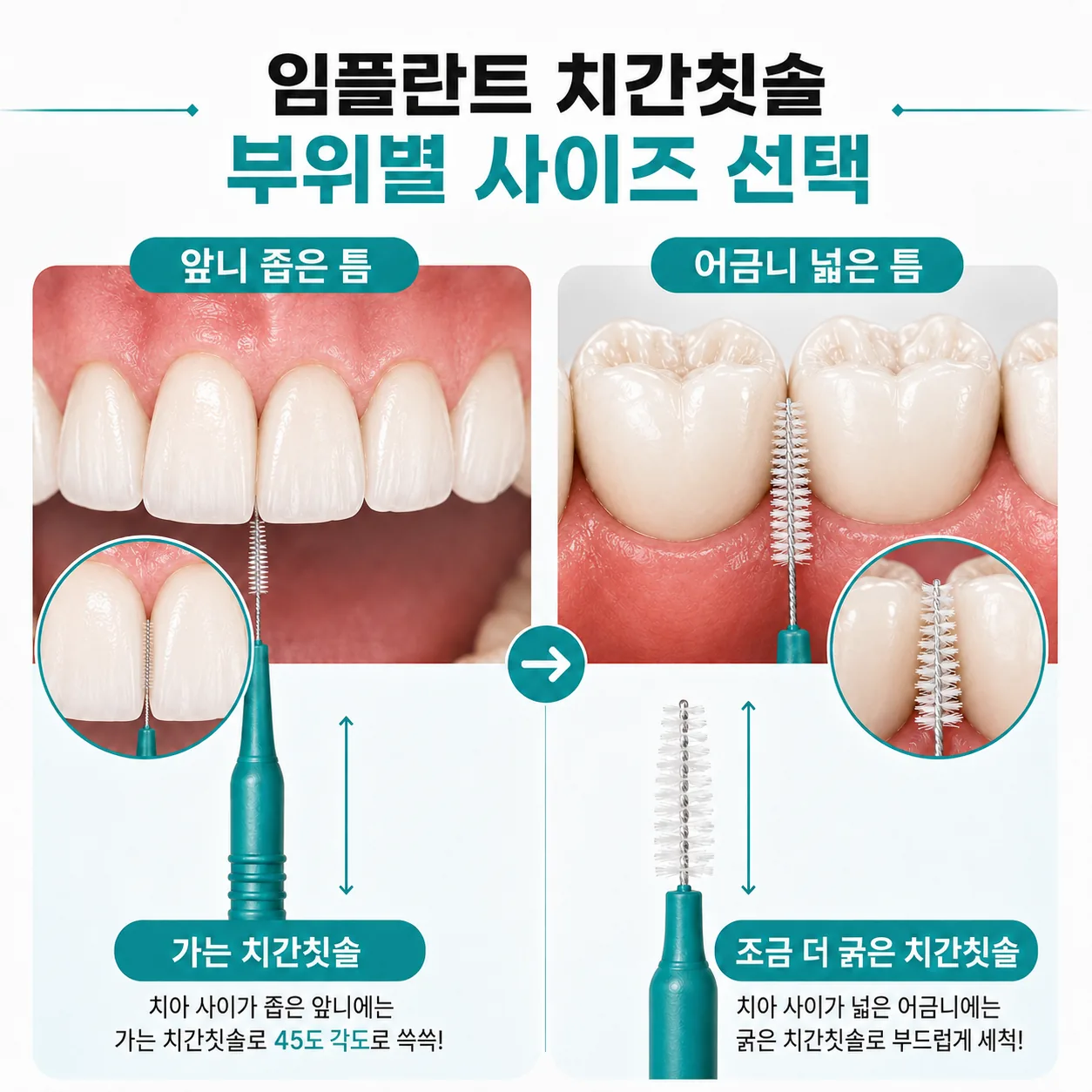 부위마다 다른 굵기를 쓰는 치간칫솔 크기 선택 도해