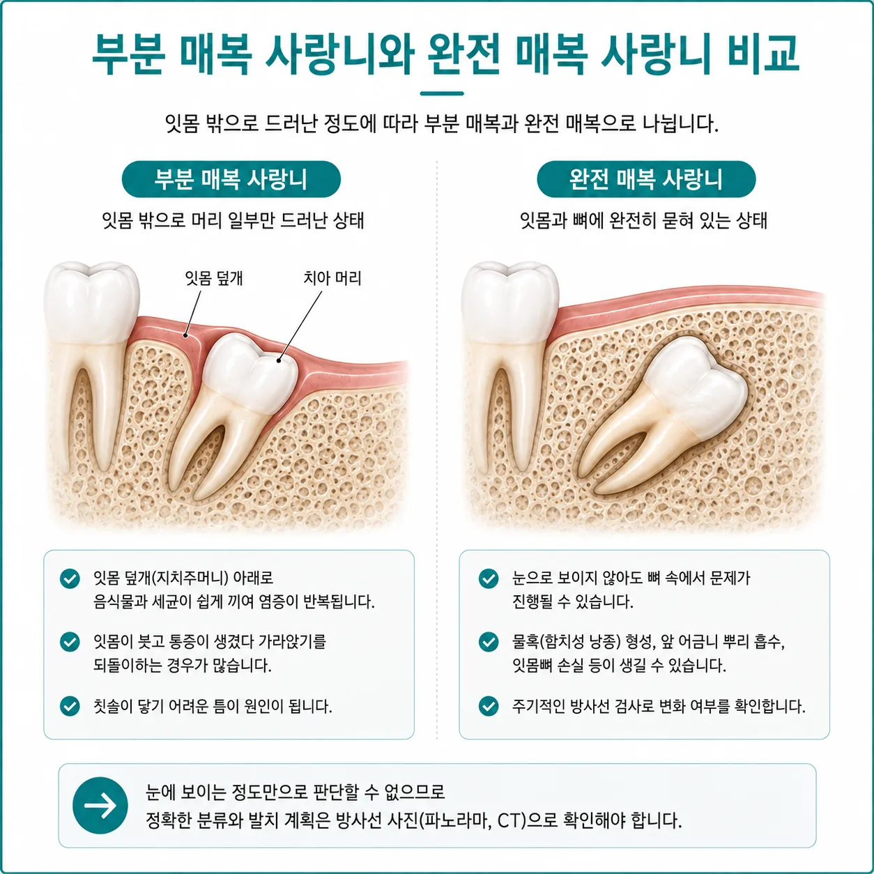 부분 매복 사랑니와 완전 매복 사랑니를 비교한 단면 도해