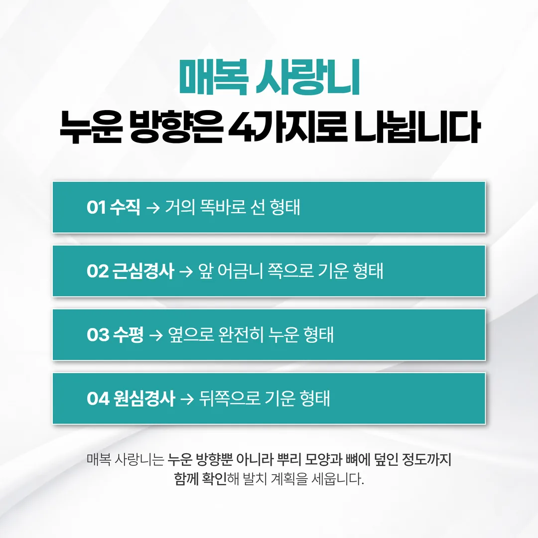 수직·근심경사·수평·원심경사로 나눈 매복 사랑니 방향 비교 도해