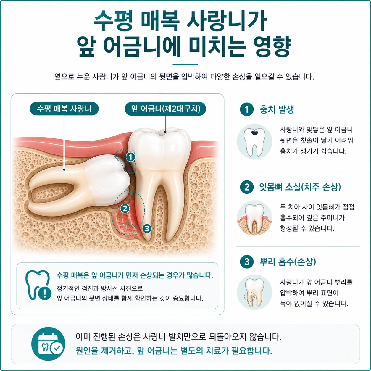 수평 매복 사랑니가 앞 어금니 뒷면에 충치와 잇몸뼈 소실을 만드는 도해
