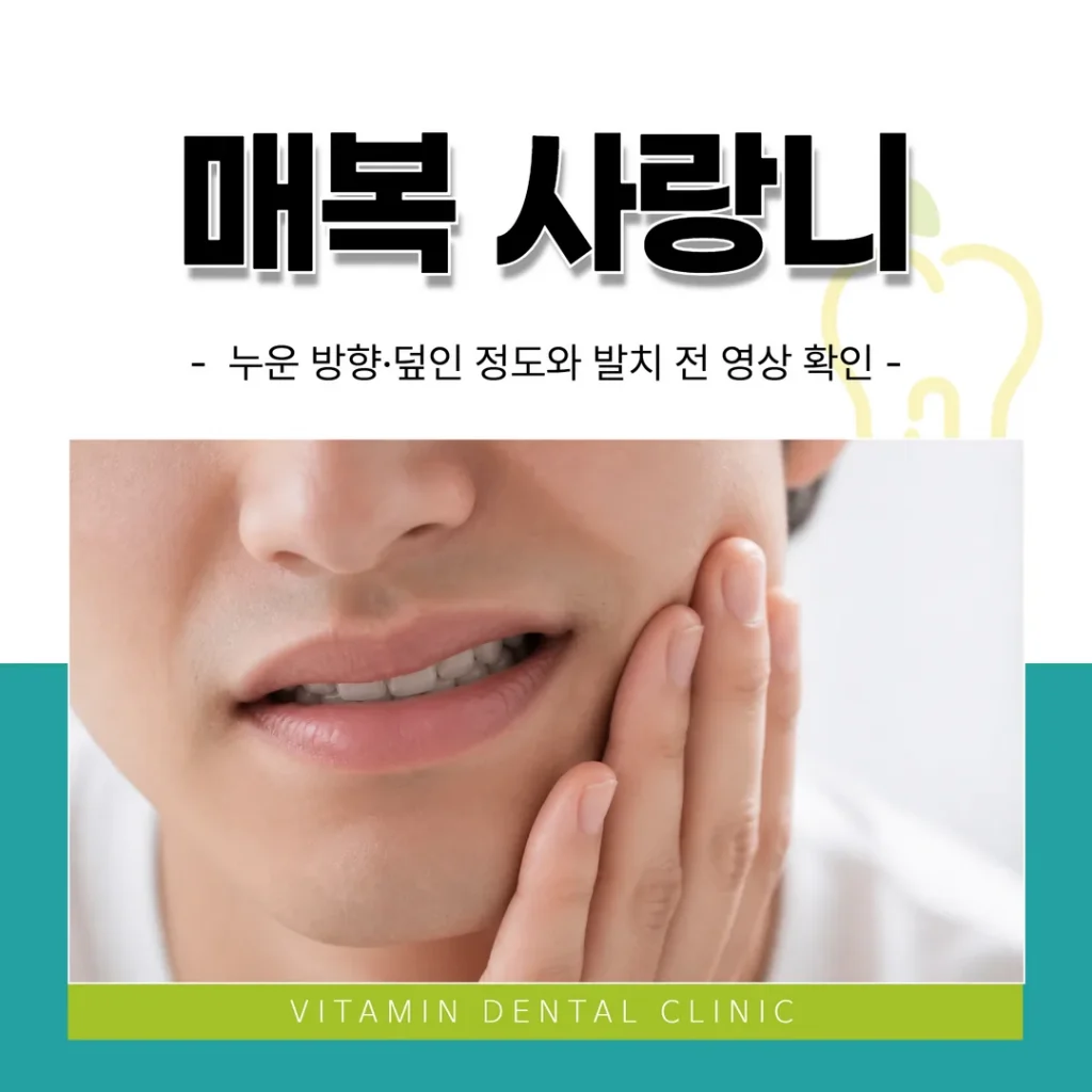 매복 사랑니 — 누운 방향·덮인 정도와 발치 전 영상 확인
