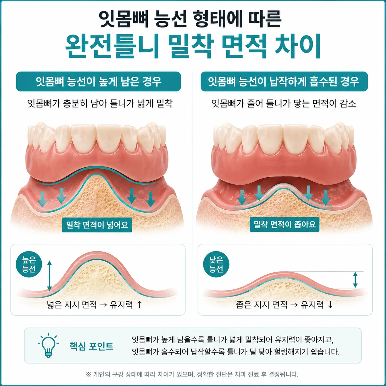 잇몸뼈 능선 흡수 정도에 따른 완전틀니 유지력 차이