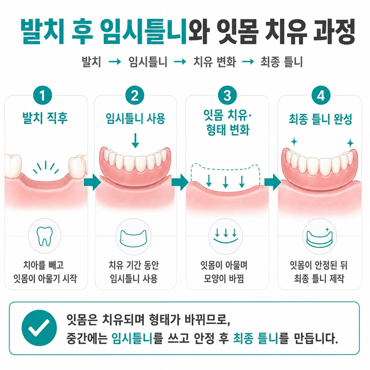 발치 후 임시틀니 단계와 잇몸 치유 경과 도해