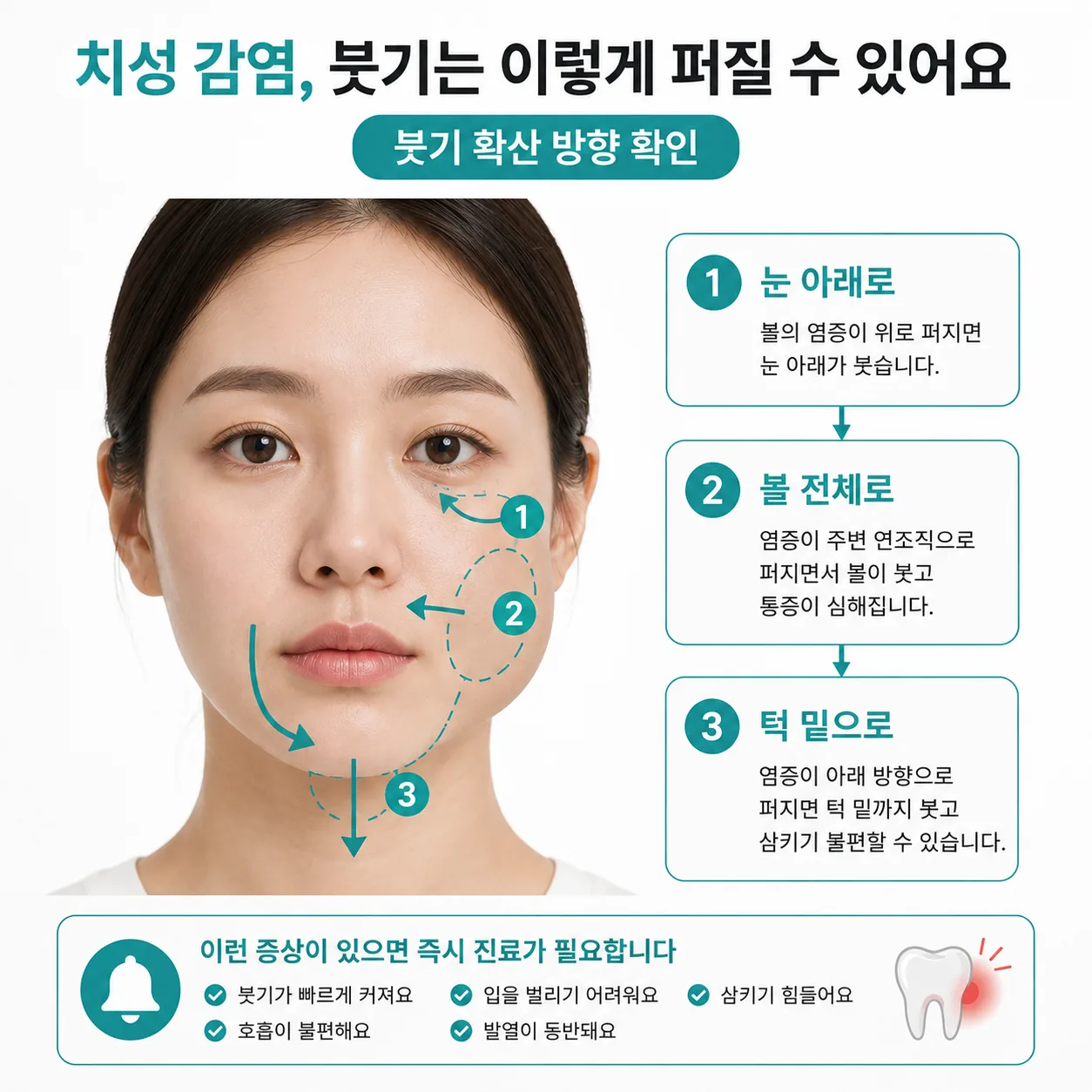 치성 감염 붓기 확산 방향 확인