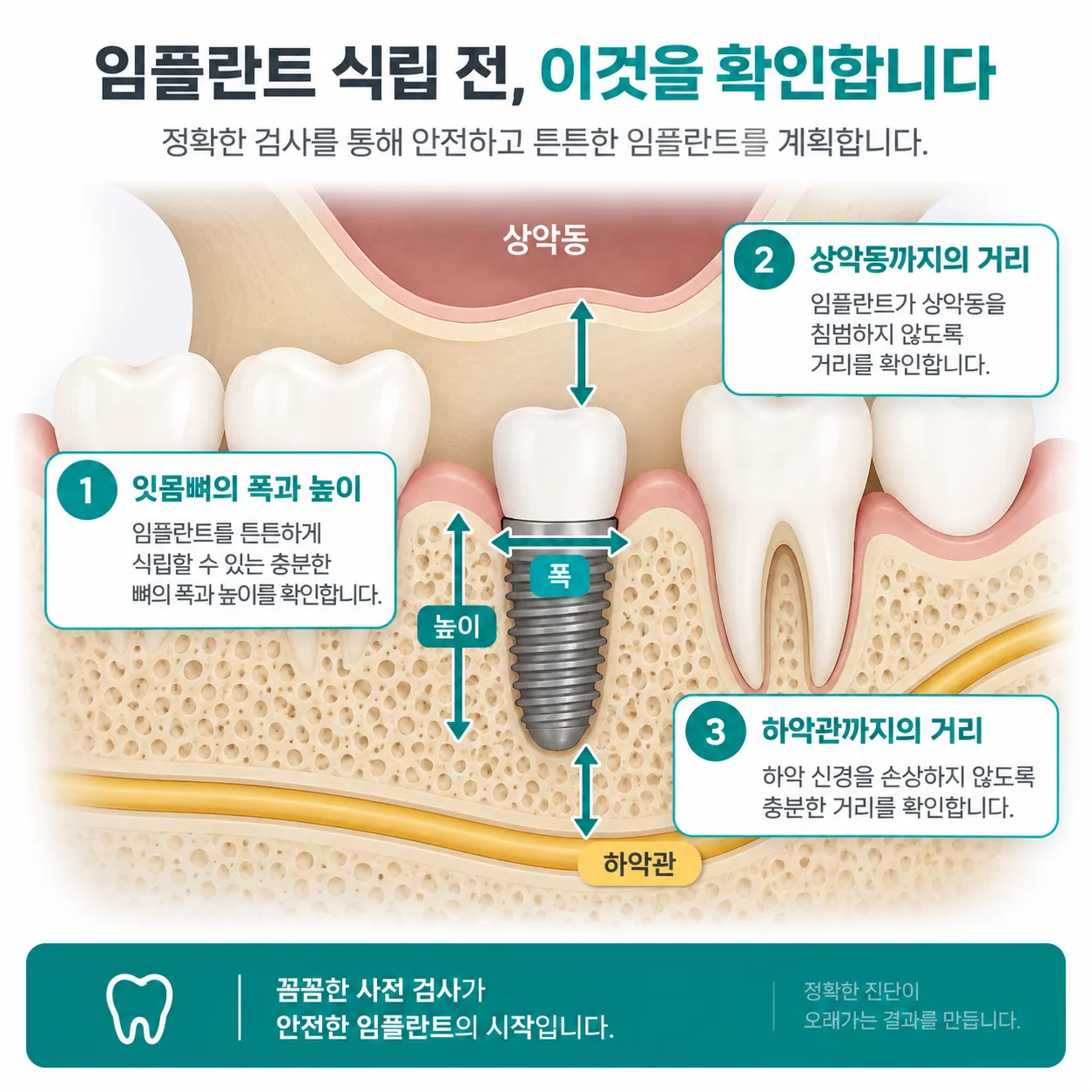 임플란트 식립 전 검사에서 확인하는 잇몸뼈 폭·높이와 상악동·하악관 거리 개념도