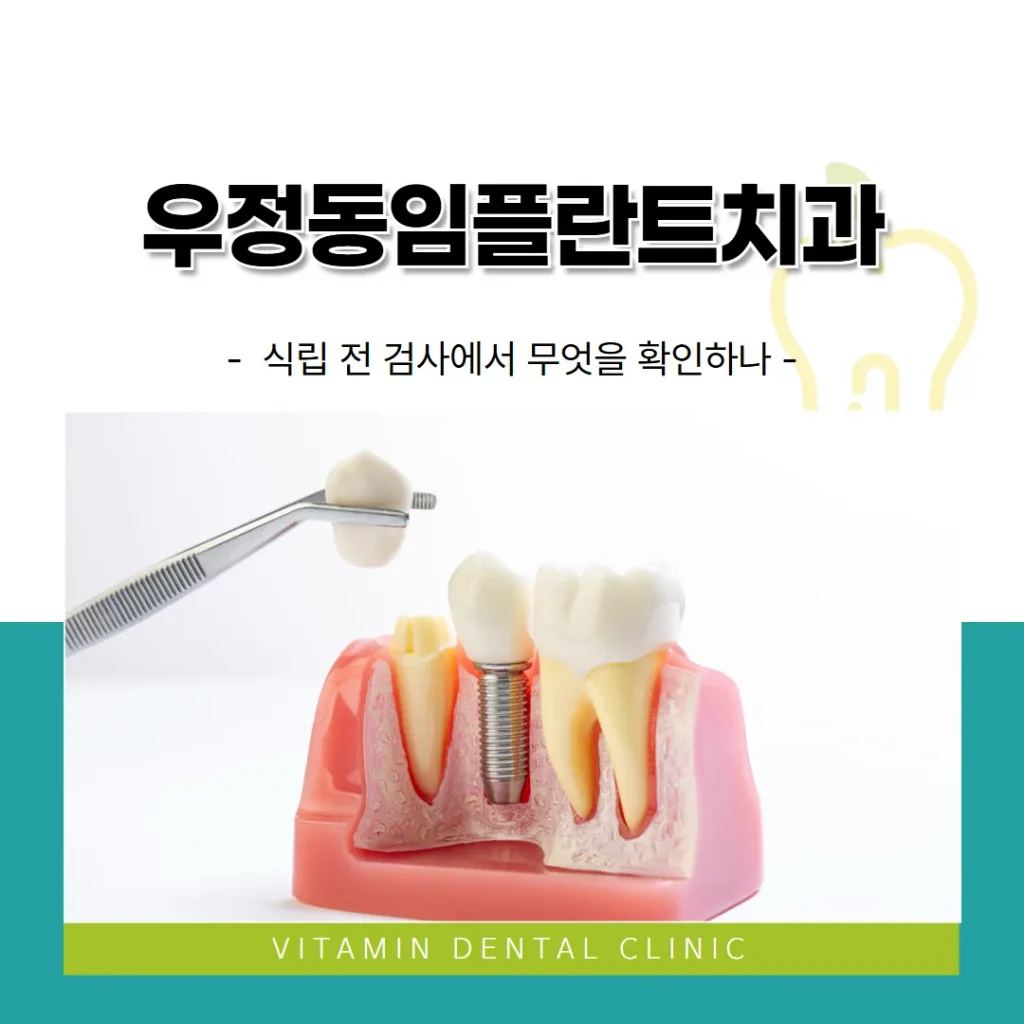 우정동임플란트치과 — 식립 전 검사에서 무엇을 확인하나