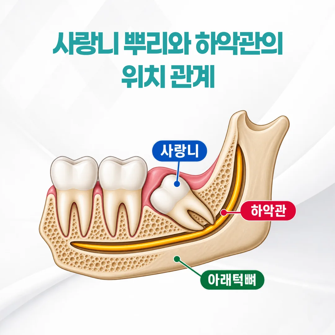 사랑니 뿌리와 하악관의 위치 관계를 나타낸 개념도