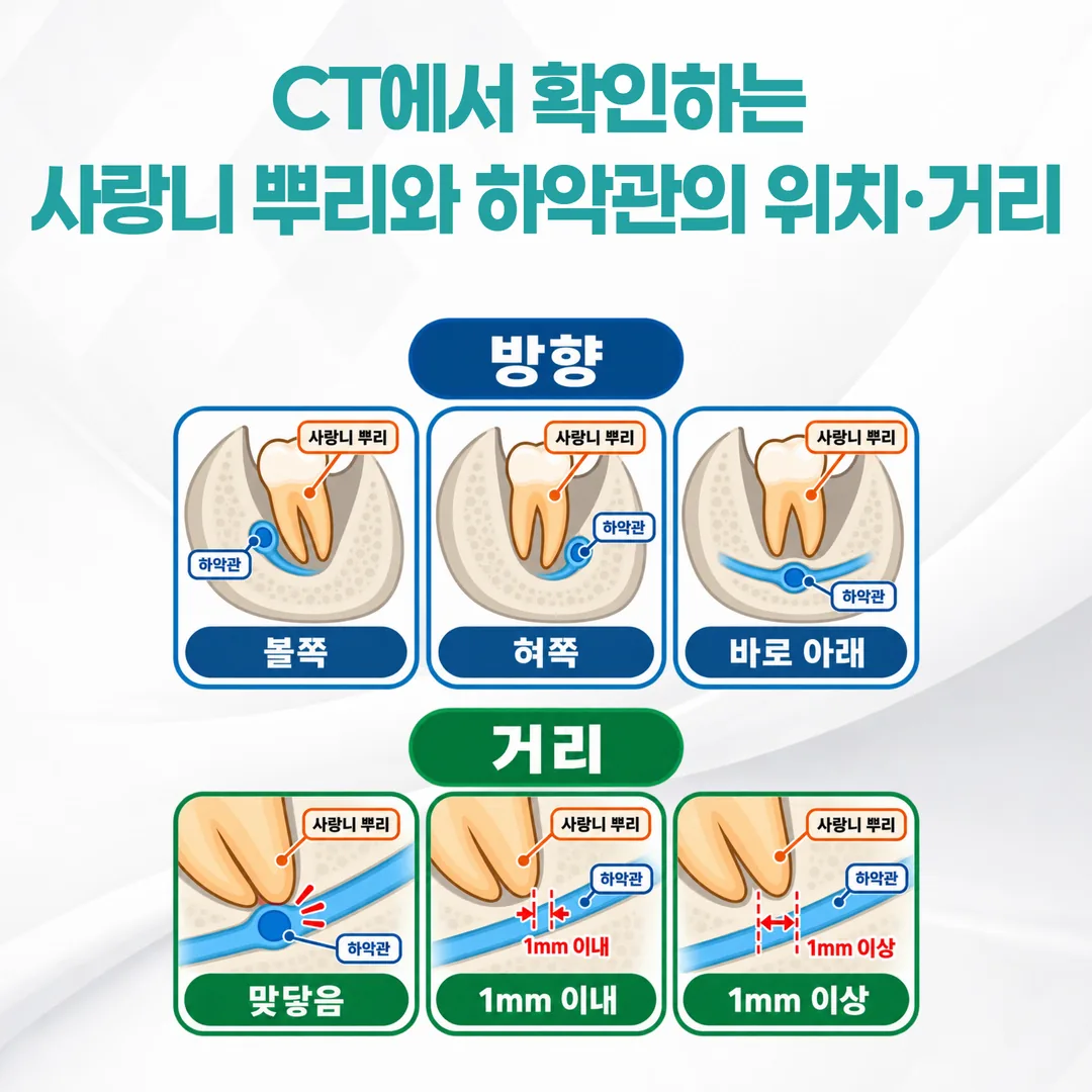 하악관의 볼 쪽·혀 쪽 위치와 뿌리까지 거리를 비교한 단면 개념도