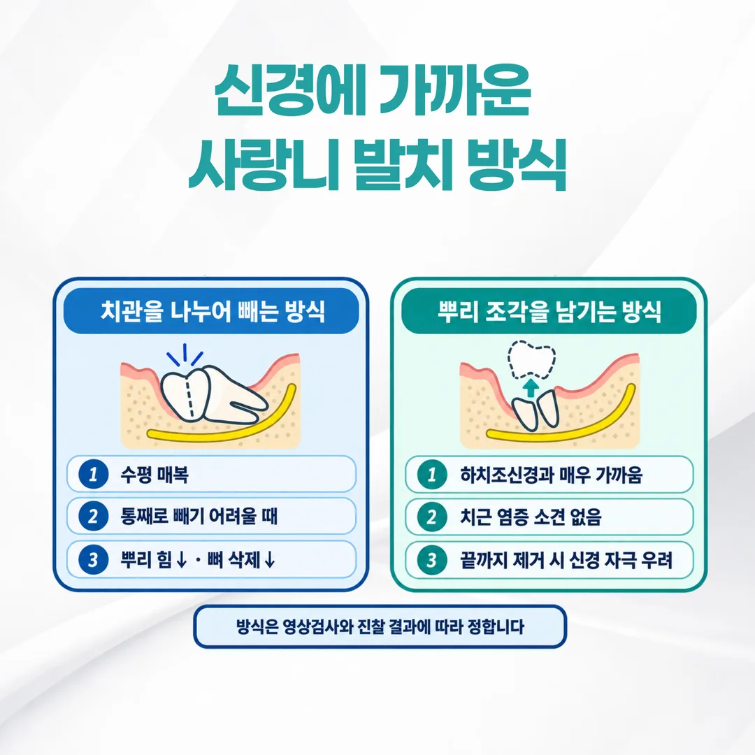 사랑니 발치 방식이 갈리는 두 갈래 도식