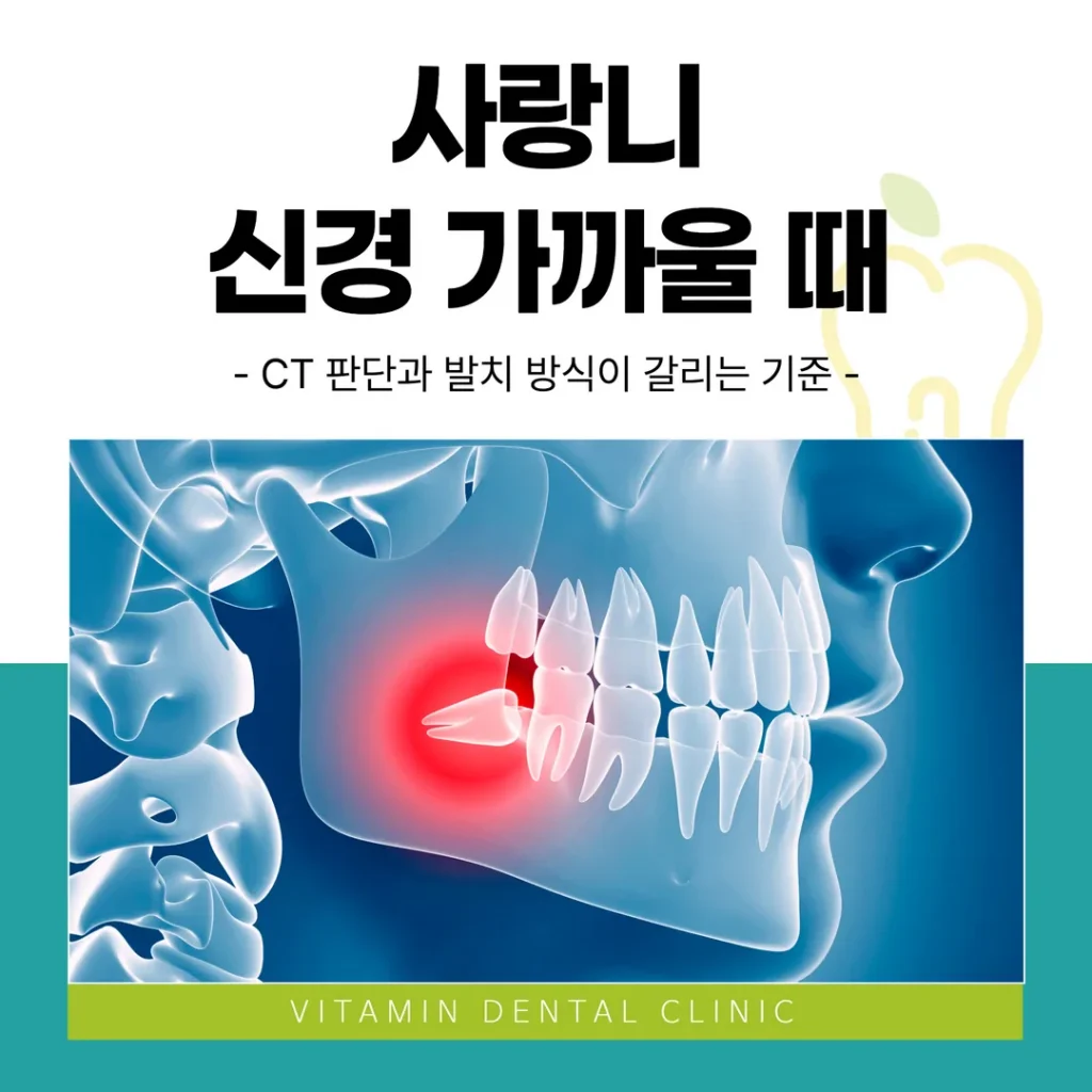 사랑니 신경 가까울 때 — CT 판단과 발치 방식이 갈리는 기준