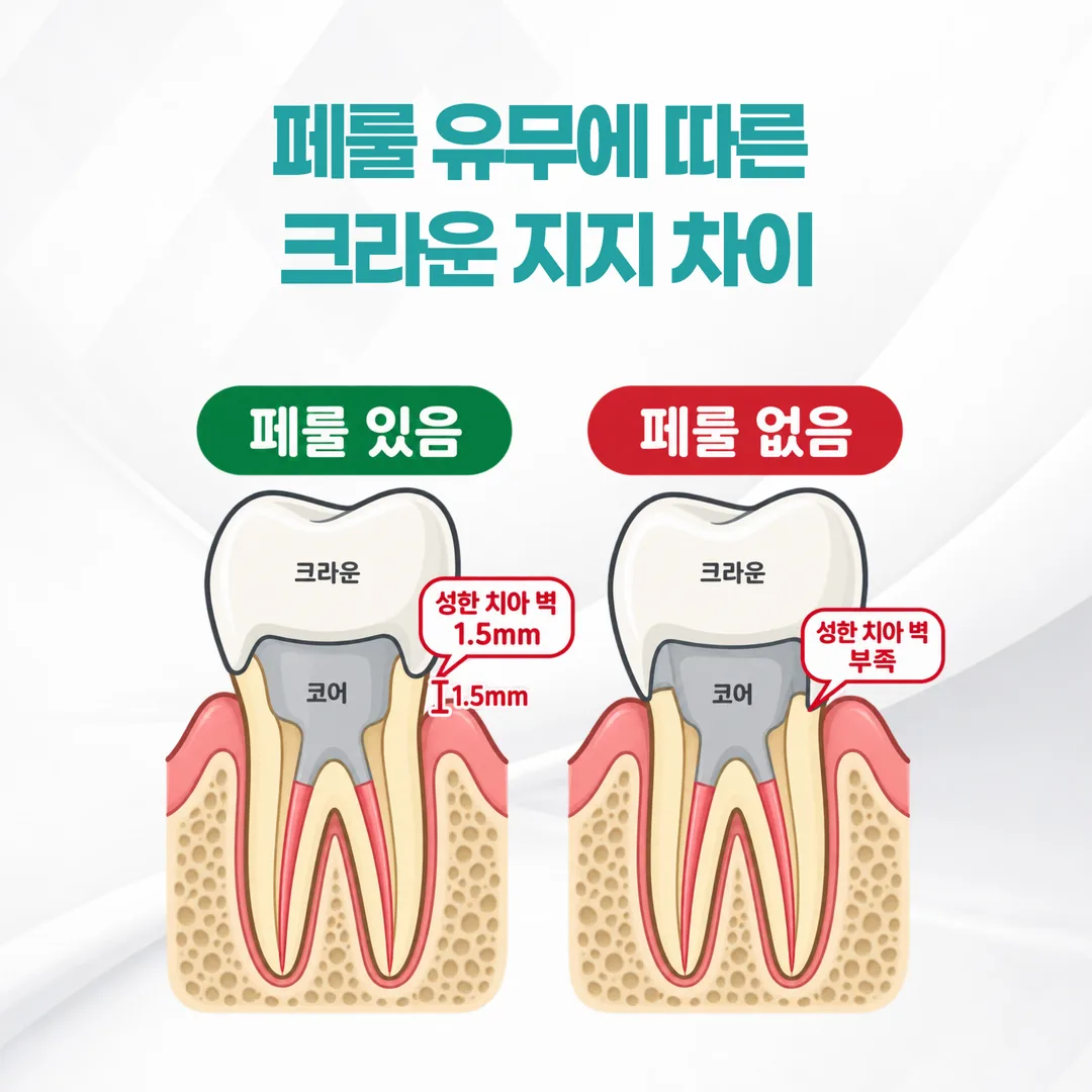 페룰 확보 여부에 따라 크라운이 붙잡는 치아 벽의 범위가 달라지는 것을 좌우로 비교한 개념도