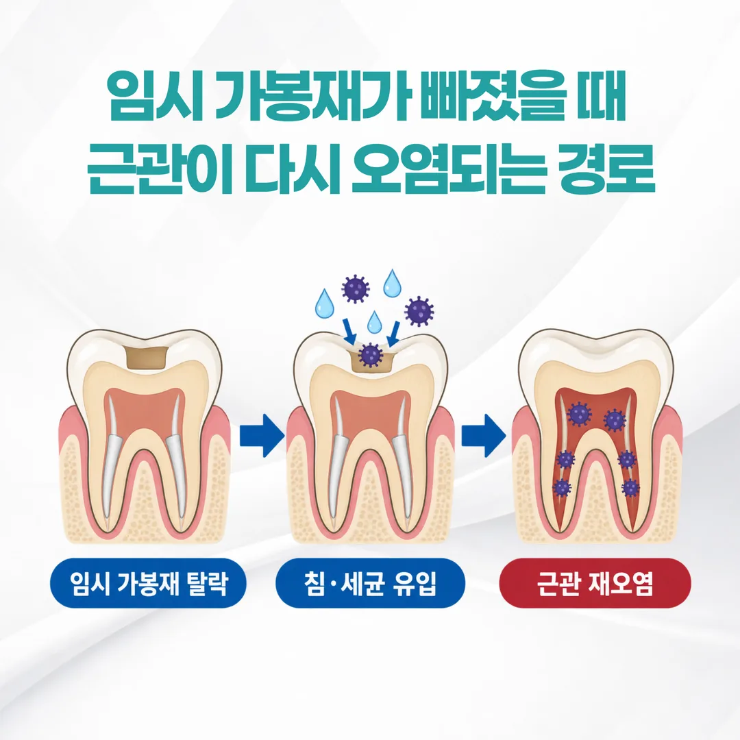 임시 가봉재가 빠졌을 때 근관이 다시 오염되는 경로를 단계별로 보여주는 설명 그림