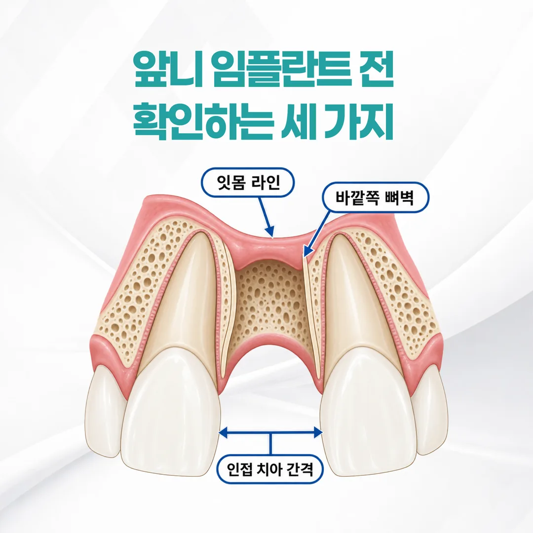 앞니 상실 부위에서 확인하는 잇몸 라인, 바깥쪽 뼈벽 두께, 인접 치아 간격을 나타낸 개념도