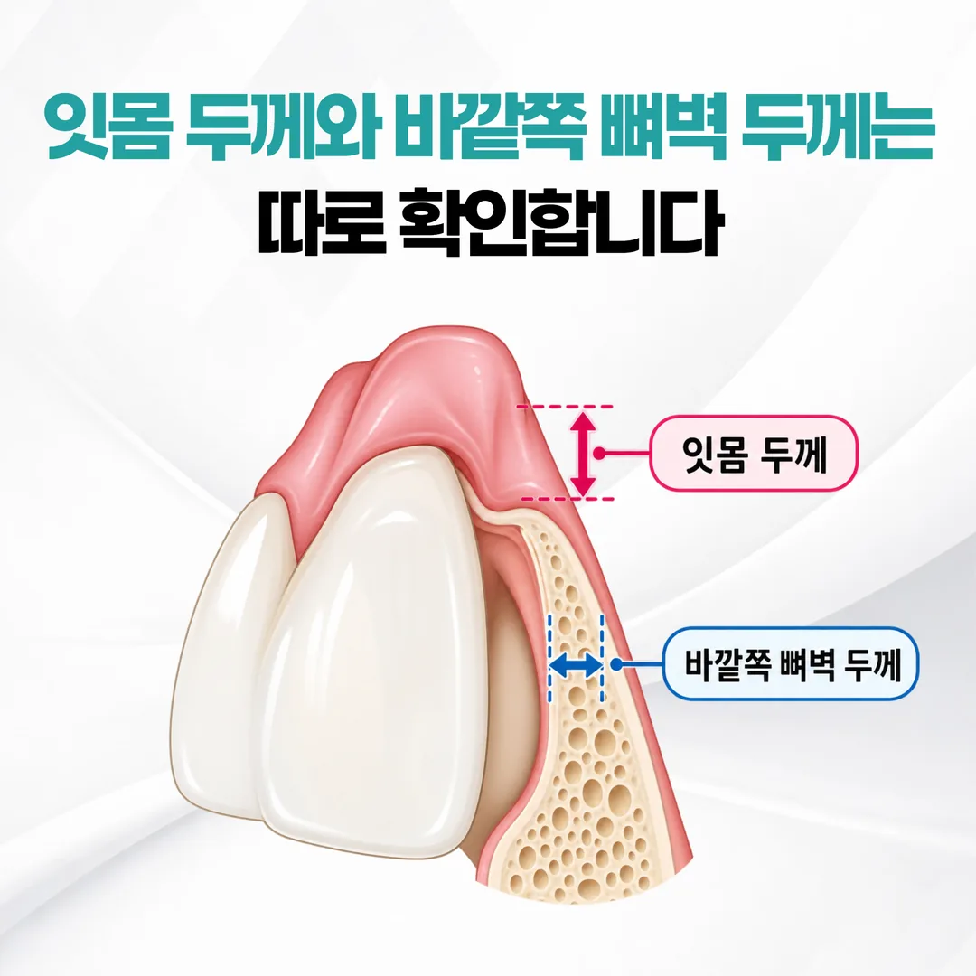 잇몸 두께와 바깥쪽 잇몸뼈 벽 두께를 각각 따로 측정하는 것을 나타낸 개념도