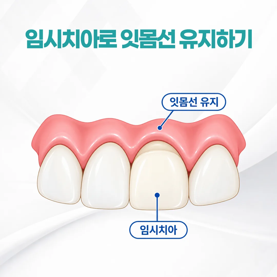 임시치아가 잇몸 선의 모양을 유지하는 구조를 나타낸 단면 개념도