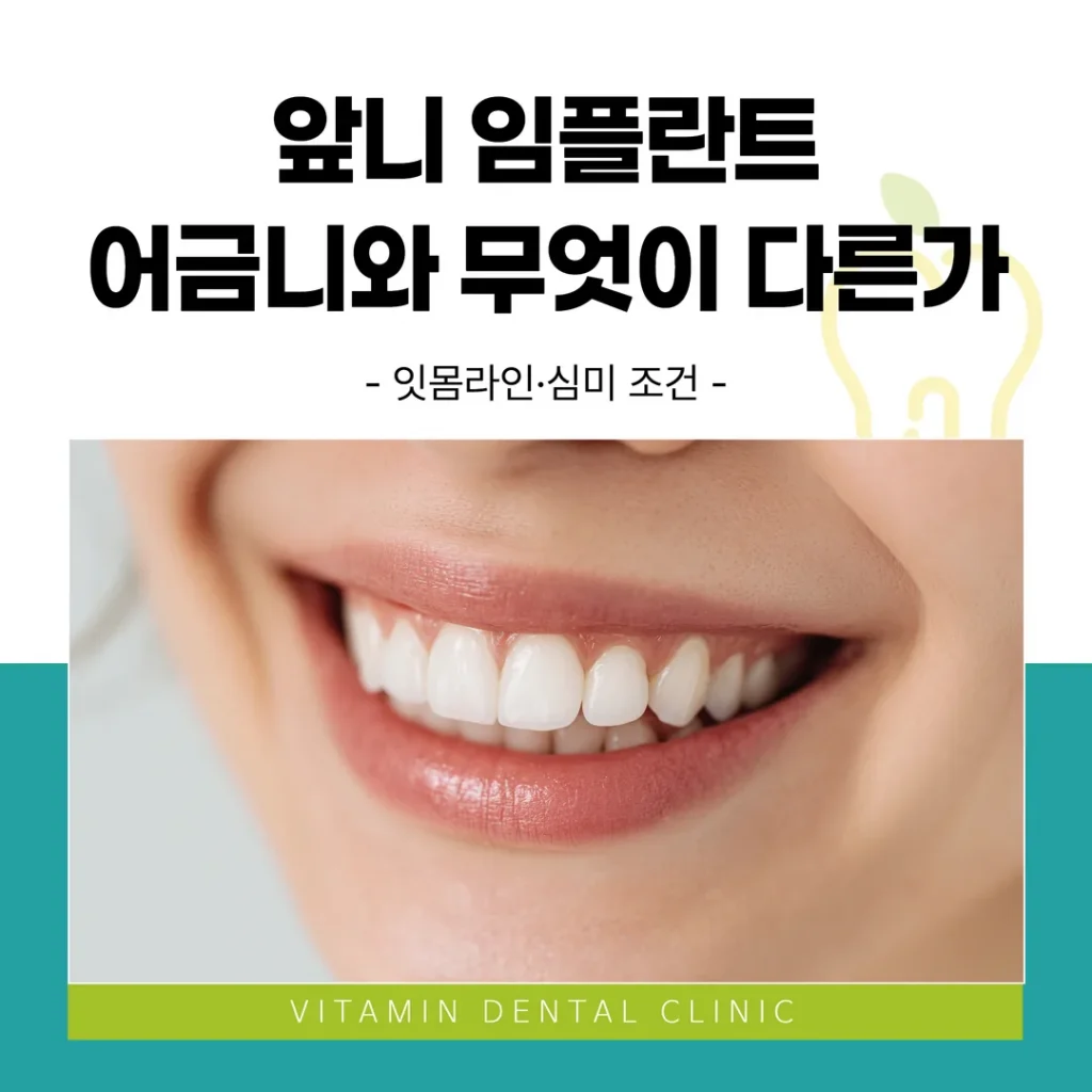 앞니 임플란트, 어금니와 무엇이 다른가 — 잇몸라인·심미 조건
