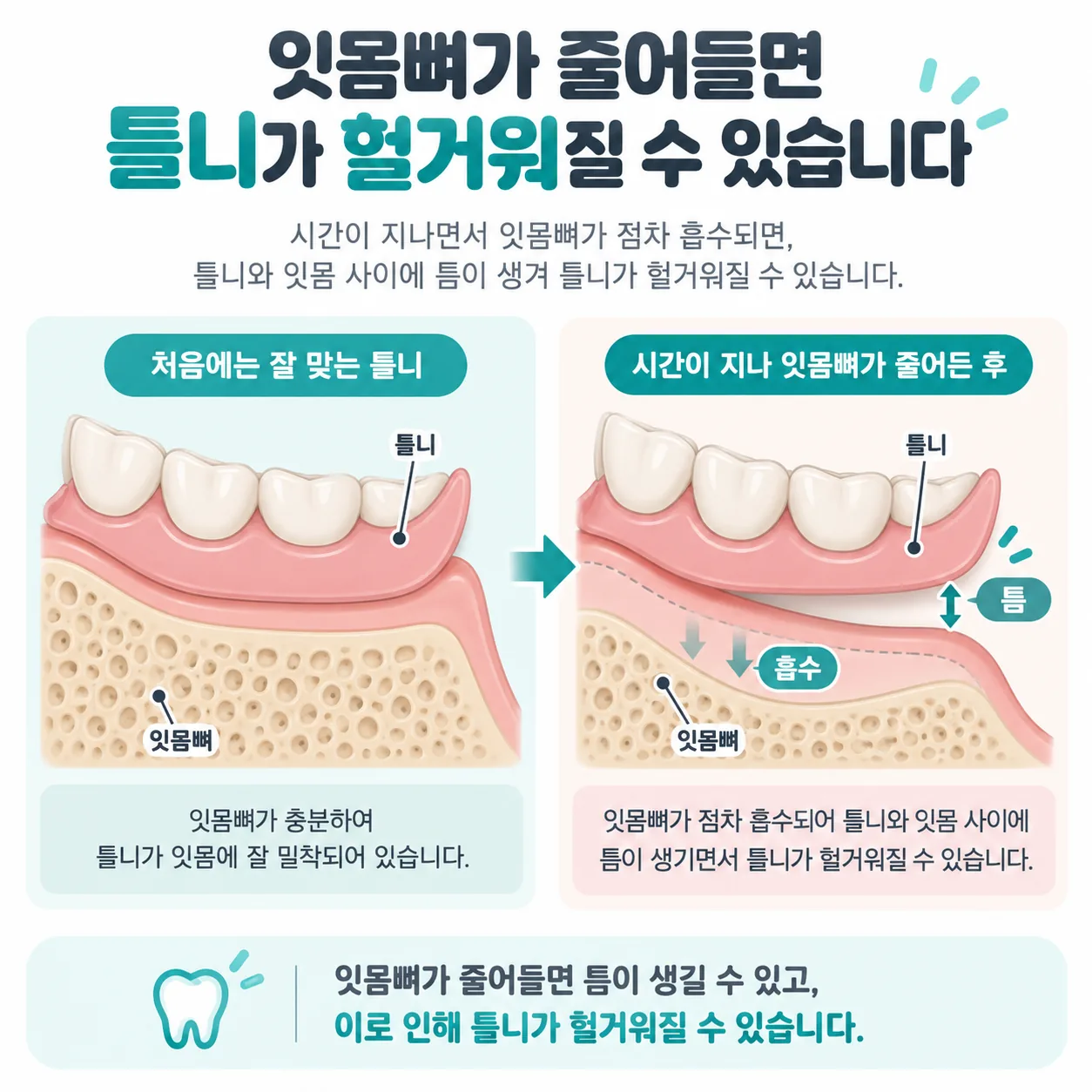 잇몸뼈가 흡수되며 틀니 내면과 잇몸 사이에 틈이 생기는 과정을 나타낸 단면 개념도