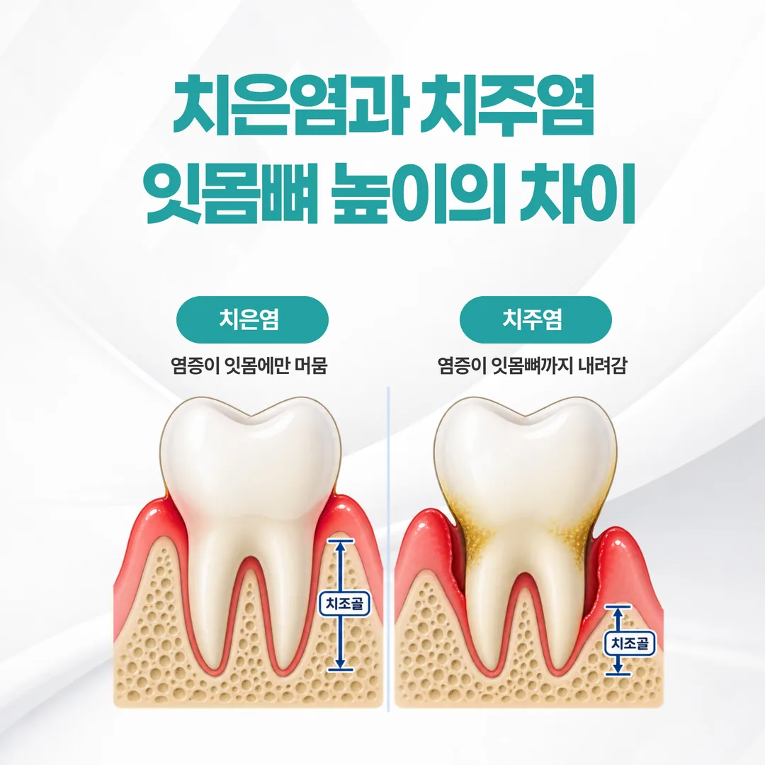 치은염과 치주염의 잇몸뼈 높이를 비교한 그림