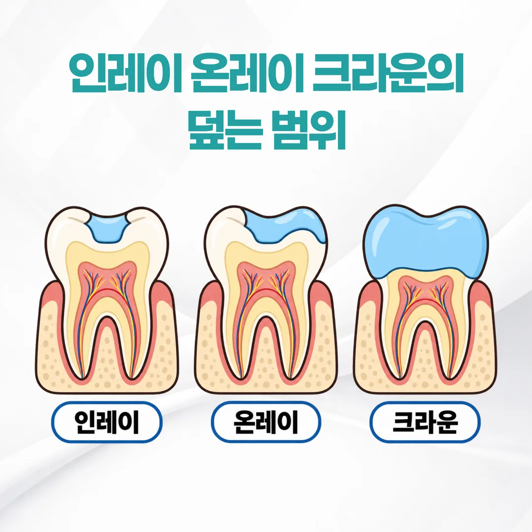 인레이 온레이 크라운의 덮는 범위를 비교한 어금니 단면 개념도