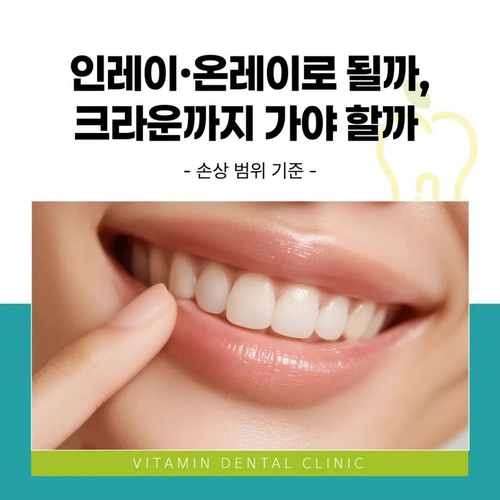 인레이·온레이로 될까, 크라운까지 가야 할까 — 손상 범위 기준