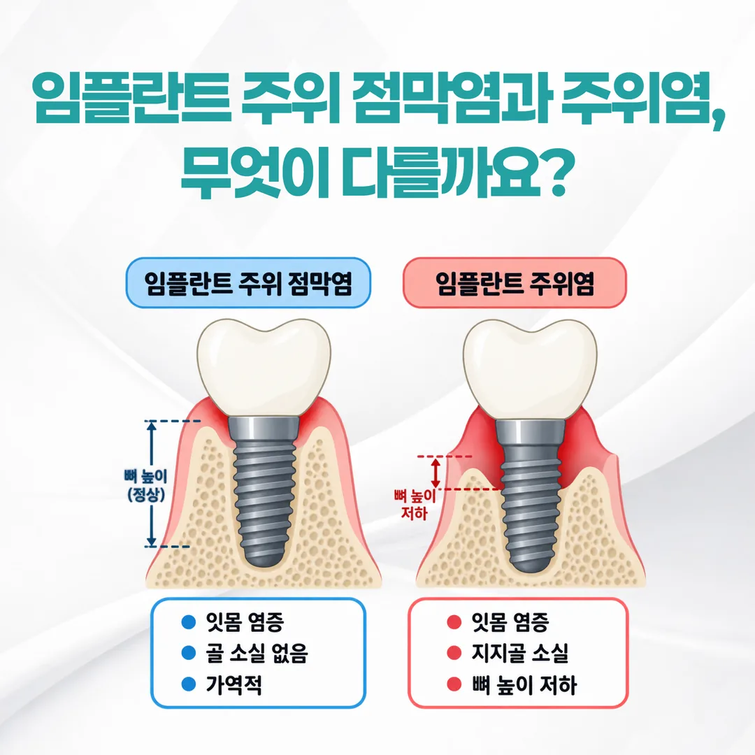 임플란트 주위 점막염과 임플란트 주위염의 차이를 잇몸과 잇몸뼈 단면으로 비교한 개념도
