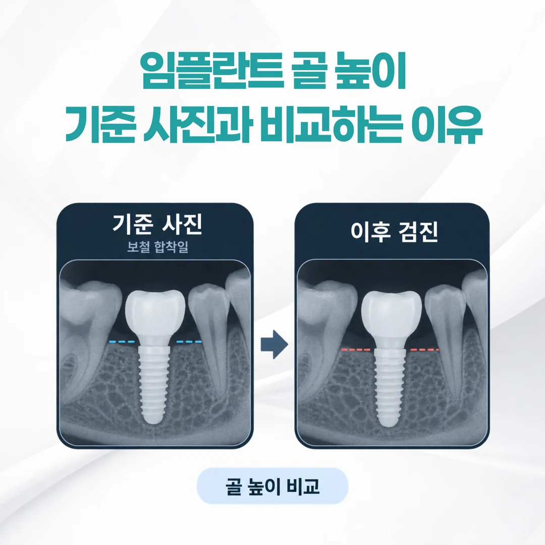 보철 합착일의 기준 방사선사진과 이후 검진 사진에서 임플란트 주위 골 높이를 비교하는 개념도