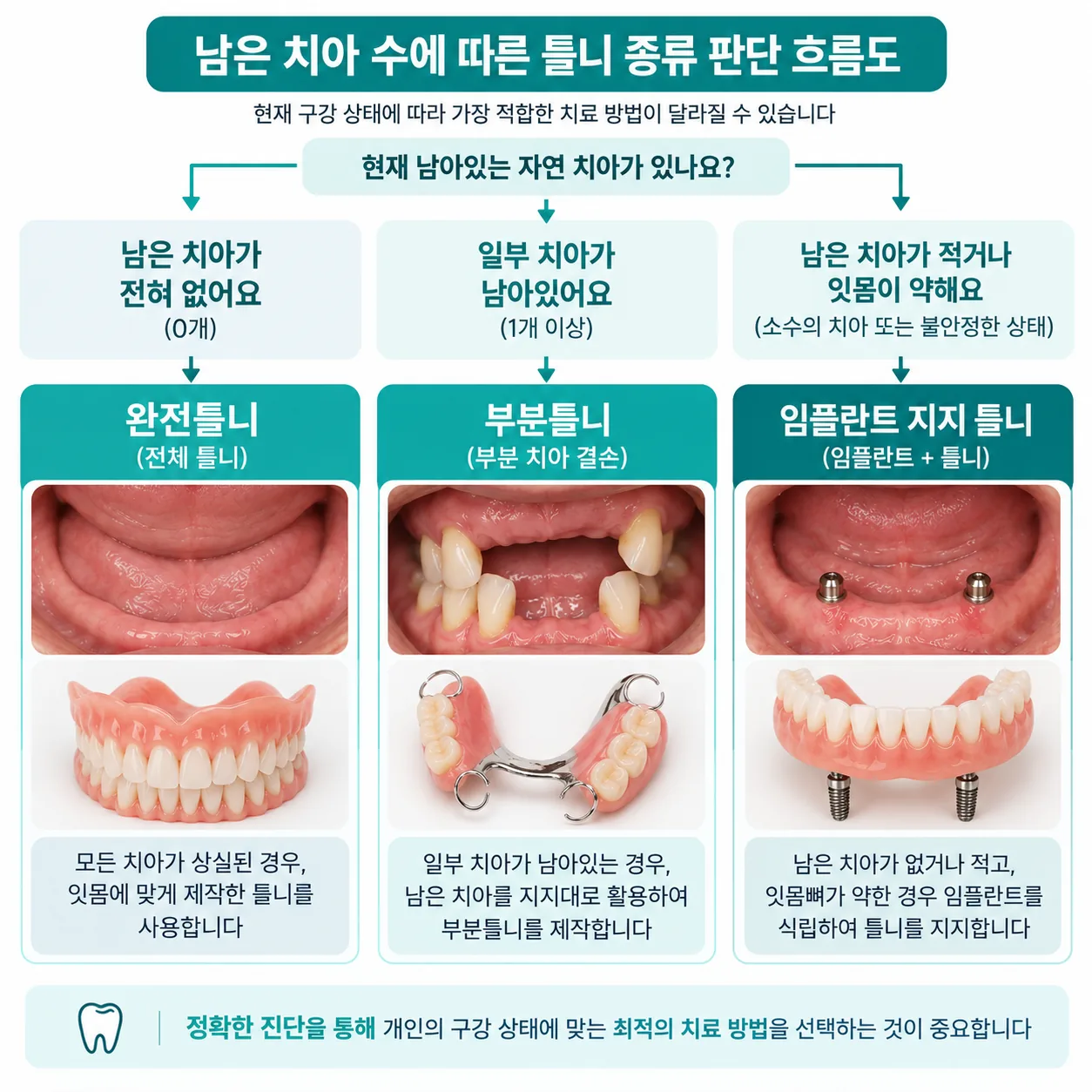 남은 치아 수에 따라 갈리는 틀니 종류 판단 흐름도