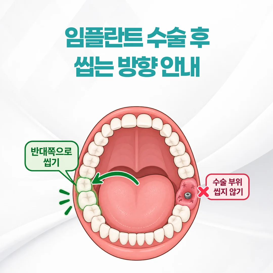임플란트 수술 부위 반대쪽 어금니로 씹는 방향을 표시한 모식도