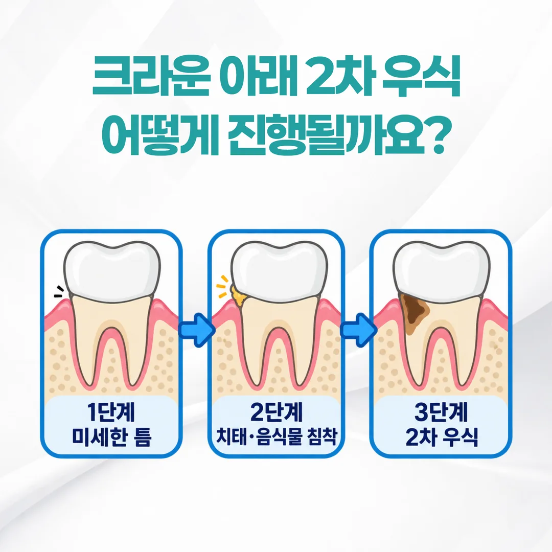 크라운 경계의 틈에서 2차 우식이 진행되는 과정을 보여 주는 단면 도식