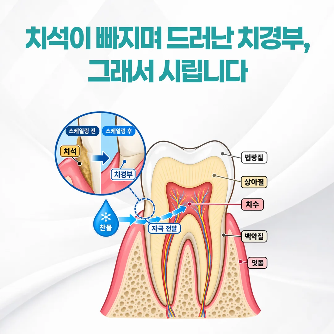 치석이 덮고 있던 치경부가 드러나 상아질을 통해 자극이 전달되는 경로를 보여주는 치아 단면 개념도
